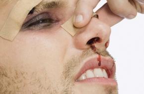 Как избежать и остановить кровотечение из носа?
